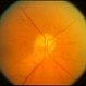 Anterior Ischemic Optic Neruopathy Anterior Ischemic Optic Neruopathy