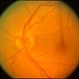 Anterior Ischemic Optic Neruopathy Anterior Ischemic Optic Neruopathy