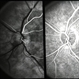 Anterior Ischemic Optic Neruopathy Anterior Ischemic Optic Neruopathy