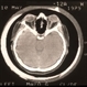Meningioma of the RE Optic Nerve Meningioma of the RE Optic Nerve