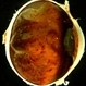 Gross Pathology - Retinal Detachment and Retinal Hemorrhage