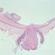 Meningioma of the RE Optic Nerve Meningioma of the RE Optic Nerve