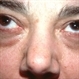 Meningioma of the RE Optic Nerve Meningioma of the RE Optic Nerve
