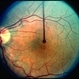Meningioma of the RE Optic Nerve Meningioma of the RE Optic Nerve