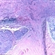 Meningioma of the RE Optic Nerve Meningioma of the RE Optic Nerve