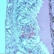 Meningioma of the RE Optic Nerve Meningioma of the RE Optic Nerve