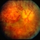 Meningioma of the RE Optic Nerve Meningioma of the RE Optic Nerve