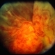 Meningioma of the RE Optic Nerve Meningioma of the RE Optic Nerve