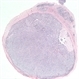 Meningioma of the RE optic nerve Meningioma of the RE optic nerve
