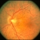 Incomplete Central Retinal Vein Occlusion V Papillophlebitis OD Incomplete Central Retinal Vein Occlusion V Papillophlebitis OD