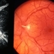 Papilledema