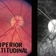 Optic Nerve Drusen Optic Nerve Drusen