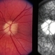 Optic Nerve Drusen Optic Nerve Drusen