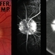 Monocular Optic Nerve Drusen Monocular Optic Nerve Drusen