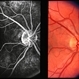 Monocular Optic Nerve Drusen Monocular Optic Nerve Drusen