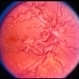Racemose Hemangioma Racemose Hemangioma