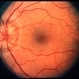 Papilledema Papilledema