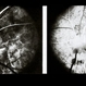 Inferior Conus of ON Inferior Conus of ON