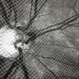 Anomalous Vasculature of Optic Nerve and Anomalous Nerve Anomalous Vasculature of Optic Nerve and Anomalous Nerve