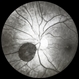 Unknown Lesion Near Optic Nerve Unknown Lesion Near Optic Nerve