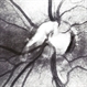 Anomalous Vasculature of Optic Nerve, Fluorescein Angiogram Anomalous Vasculature of Optic Nerve, Fluorescein Angiogram