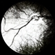 Anomalous Vasculature of Optic Nerve and Anomalous Nerve Anomalous Vasculature of Optic Nerve and Anomalous Nerve