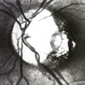Optic Nerve Head Pit Optic Nerve Head Pit