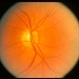 Optic Nerve Pit v Coloboma Optic Nerve Pit v Coloboma