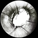 Optic Nerve Head Pit Optic Nerve Head Pit