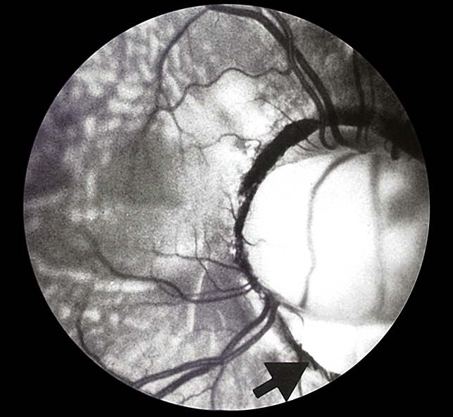 Coloboma of Optic Nerve With NonRhegmatogenous Retinal Detachment