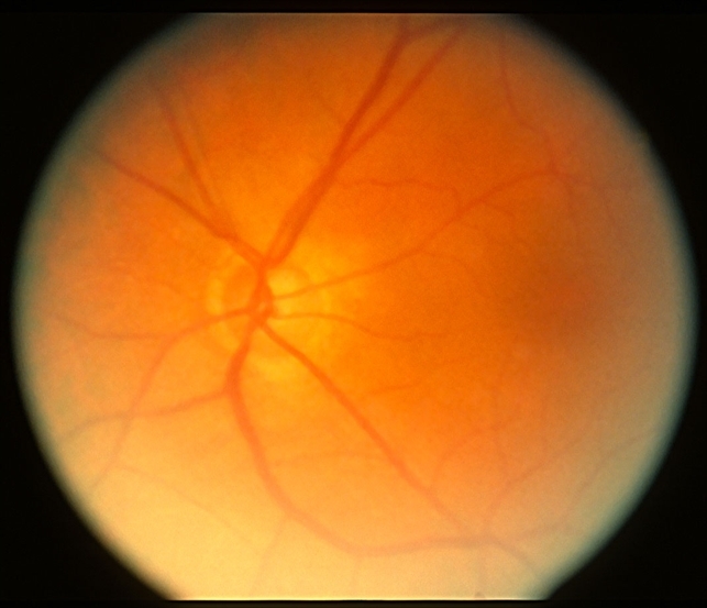 Optic Nerve Pit v Coloboma / fellow eye - Retina Image Bank