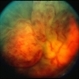 Meningioma of the RE Optic Nerve Meningioma of the RE Optic Nerve