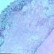 Meningioma of the RE Optic Nerve Meningioma of the RE Optic Nerve