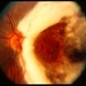Myelinated Nerve Fibers and Possibly Posterior Staphyloma Myelinated Nerve Fibers and Possibly Posterior Staphyloma
