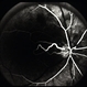 Cilioretinal Artery to Central Retinal Vein Anastomosis