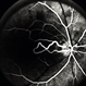 Cilioretinal Artery to Central Retinal Vein Anastomosis