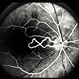Cilioretinal Artery to Central Retinal Vein Anastomosis