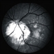 Inferior Optic Nerve Coloboma;  red free Inferior Optic Nerve Coloboma;  red free