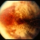 Myelinated Nerve Fibers and Possibly Posterior Staphyloma Myelinated Nerve Fibers and Possibly Posterior Staphyloma