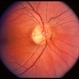 Optic Pit; two in one nerve Optic Pit; two in one nerve