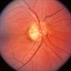 Optic Pit; two in one nerve Optic Pit; two in one nerve