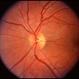 Optic Pit; two in one nerve Optic Pit; two in one nerve