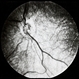 Optic Disc Hypoplasia With Double Ring Sign Optic Disc Hypoplasia With Double Ring Sign