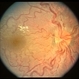 Hypertensive Retinopathy/ Fellow Eye