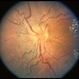 Hypertensive Retinopathy and Optic Nerve Hypoplasia Hypertensive Retinopathy and Optic Nerve Hypoplasia