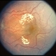 Hypertensive Retinopathy and Optic Nerve Hypoplasia Hypertensive Retinopathy and Optic Nerve Hypoplasia