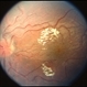 Hypertensive Retinopathy and Optic Nerve Hypoplasia Hypertensive Retinopathy and Optic Nerve Hypoplasia