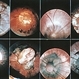 Probably Various ON Colobomas Probably Various ON Colobomas