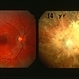 Probable Optic Nerve Coloboma Probable Optic Nerve Coloboma