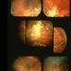 Probable Optic Nerve Coloboma Probable Optic Nerve Coloboma